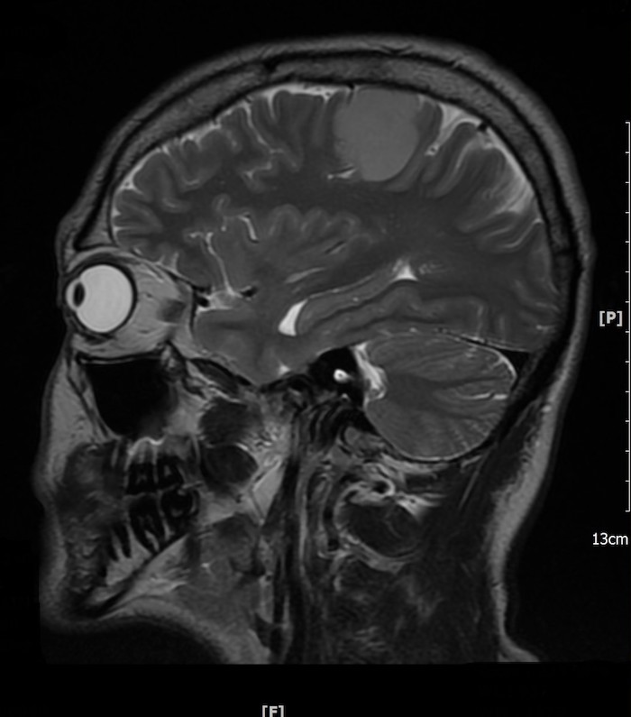 Obraz MRI glejaka o niskim stopniu złośliwości rys.3
