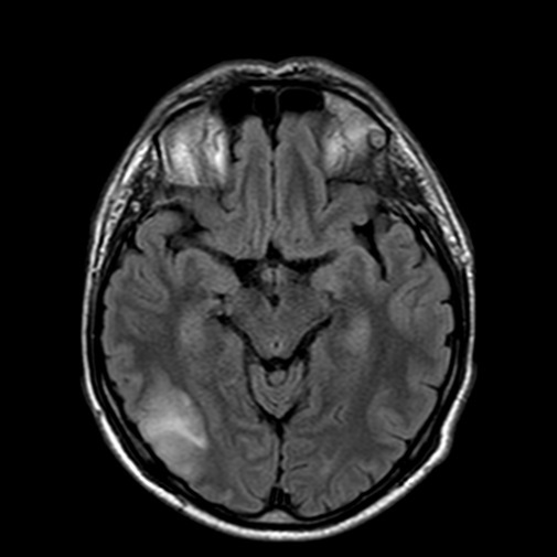 Obraz MRI glejaka o niskim stopniu złośliwości 