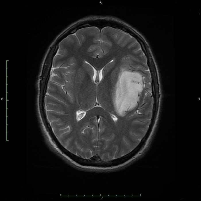 Obraz MRI glejaka o niskim stopniu złośliwości rys. 2