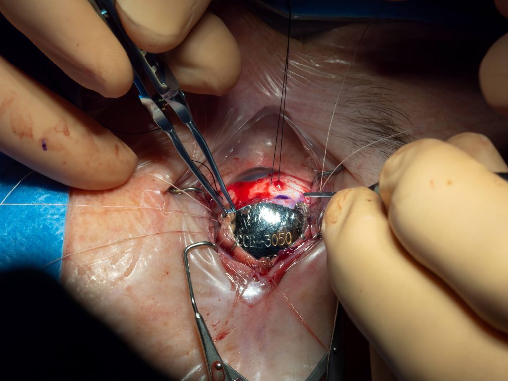 Zdjęcie z zabiegu wszczepienia aplikatora z Ru-106 na ścianę gałki ocznej u pacjenta z czerniakiem naczyniówki