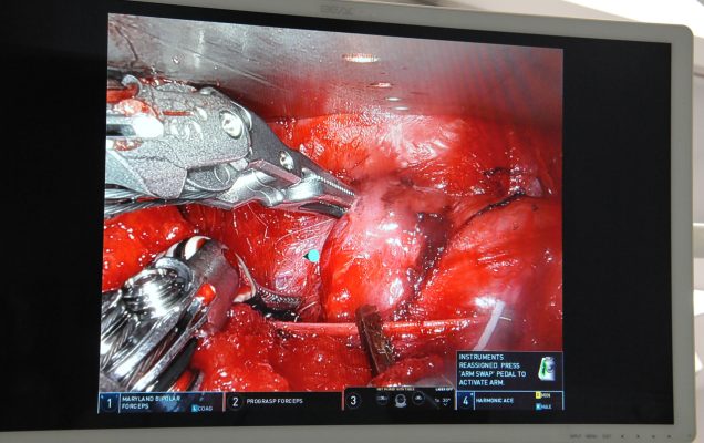 operacja-robotyczna-tarczycy-z-dojsciem-przez-pache_21
