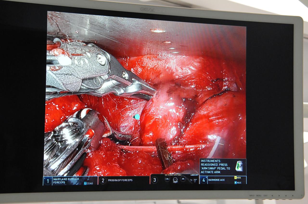 operacja-robotyczna-tarczycy-z-dojsciem-przez-pache_21