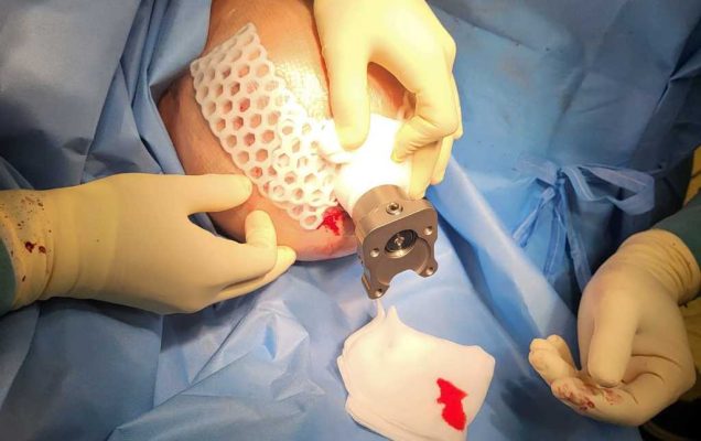 operacja osseointegracji w wojskowym instytucie medycznym w warszawie. Zdjęcie operacji kończyny.