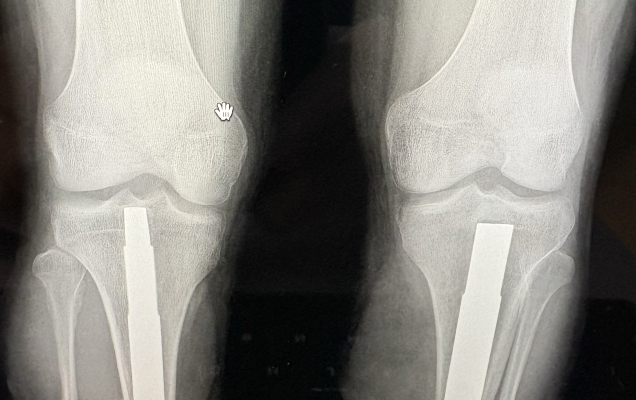 Zdjęcie RTG kończyn.