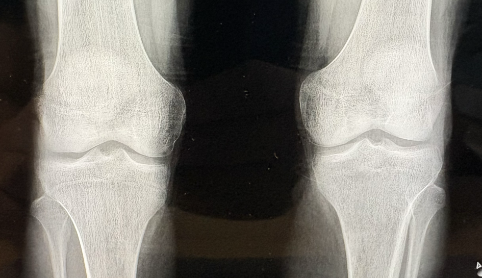 Zdjęcie RTG kończyn.