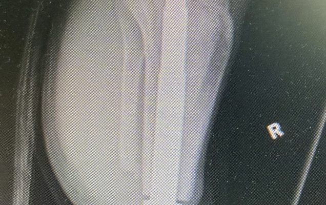 Zdjęcie RTG kończyny prawej.