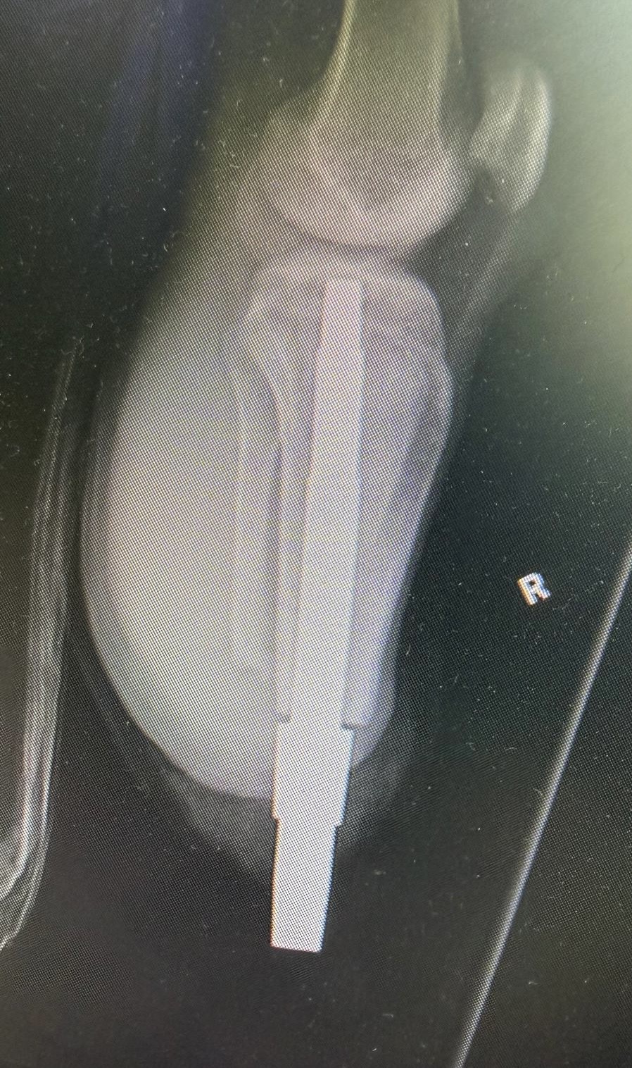 Zdjęcie RTG kończyny prawej.