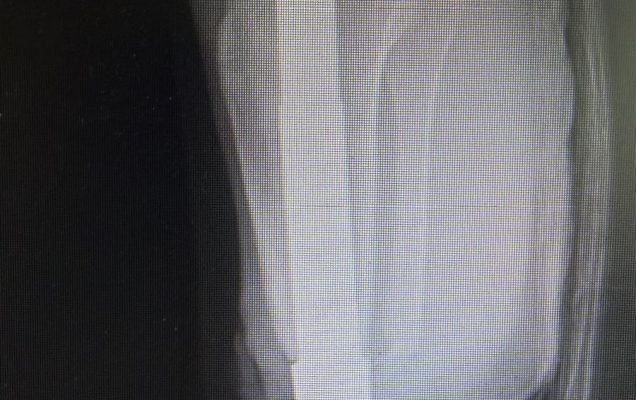 Zdjęcie RTG kończyny lewej.