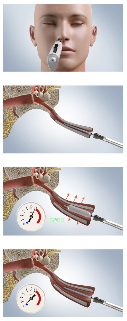 4 elementowa Infografika zabiegu balnoplastyki. Na pierwszym ujęciu widać model ludzkiej głowy z przyłożonym do nosa urządzeniem medycznym. Na 3 pozostałych grafikach zabieg balnoplastyki.